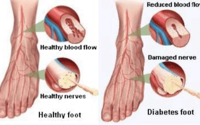 Treatment Recommendation for Diabetic Foot Ulcers (DFUs) by the Wound Healing Society