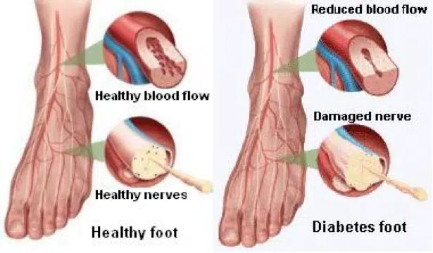 Treatment Recommendation for Diabetic Foot Ulcers (DFUs) by the Wound Healing Society