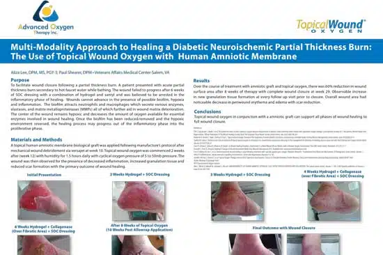 Clinical Evidence 13 Diabetic Neuroischemic Partial Thickness Burn: The Use of Topical Wound Oxygen with Human Amniotic Membrane 4 Weeks