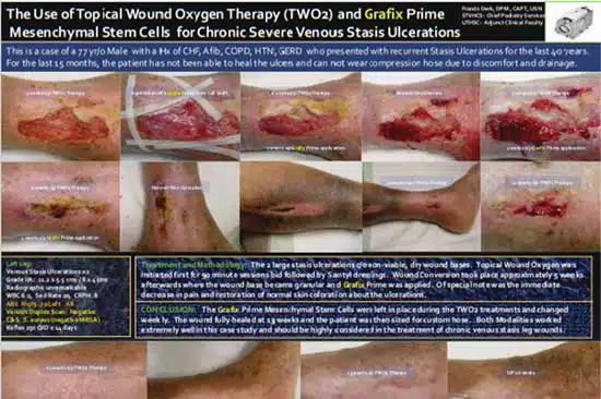 The Use of Topical Wound Oxygen Therapy (TWO2) and Grafix Prime Mesenchyinal Stem Cells for Chronic Venous Stasis Ulcerations