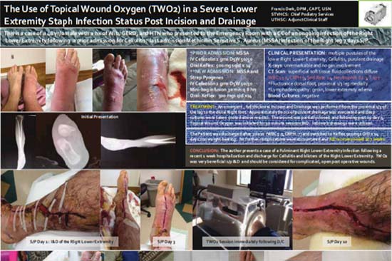 The Use of Topical Wound Oxygen (TWO2) in a Severe Lower Extremity  Staph Infection Staus Post Incision and Drainage