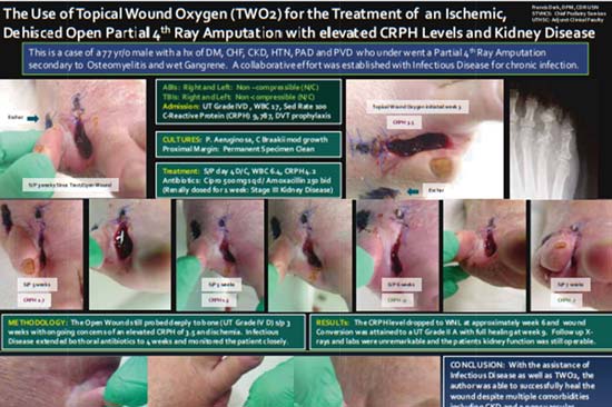 The Use of Topical Wound Oxygen (TWO2) for the Treatment of Ischemic, Dehisced Open Partial 4th Ray Amputation with Elevated CRPH Levels and Kidney Disease
